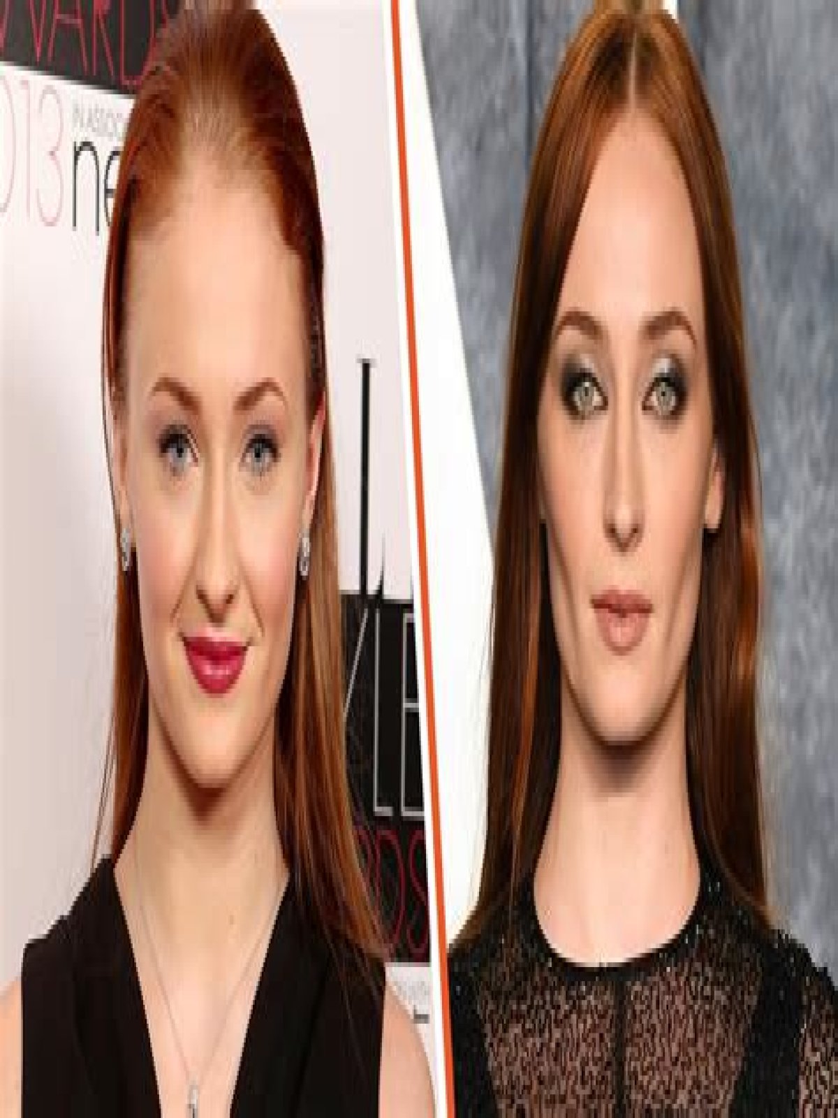 Unveiling The Transformation: Sophie Turner And Buccal Fat Removal